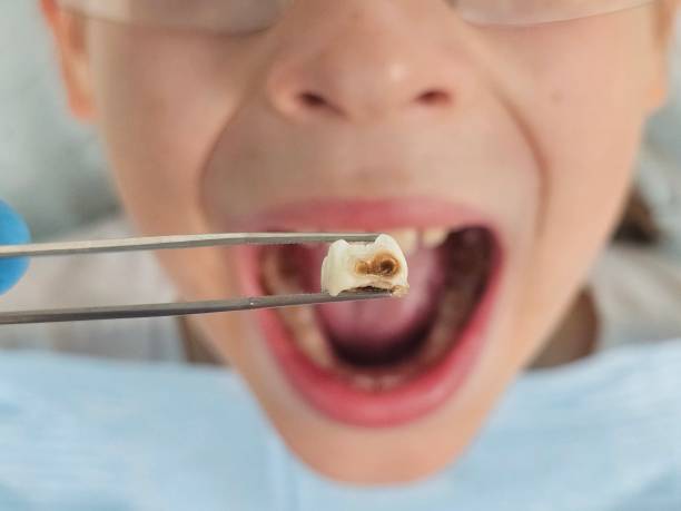 Best Dentist for Tooth Abscess  in Orida City, FL
